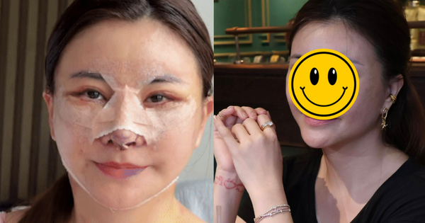 Nữ diễn viên Việt vừa phẫu thuật thẩm mỹ mặt ở Hàn Quốc bị chê mạnh, phải vội lên tiếng làm rõ 1 thông tin