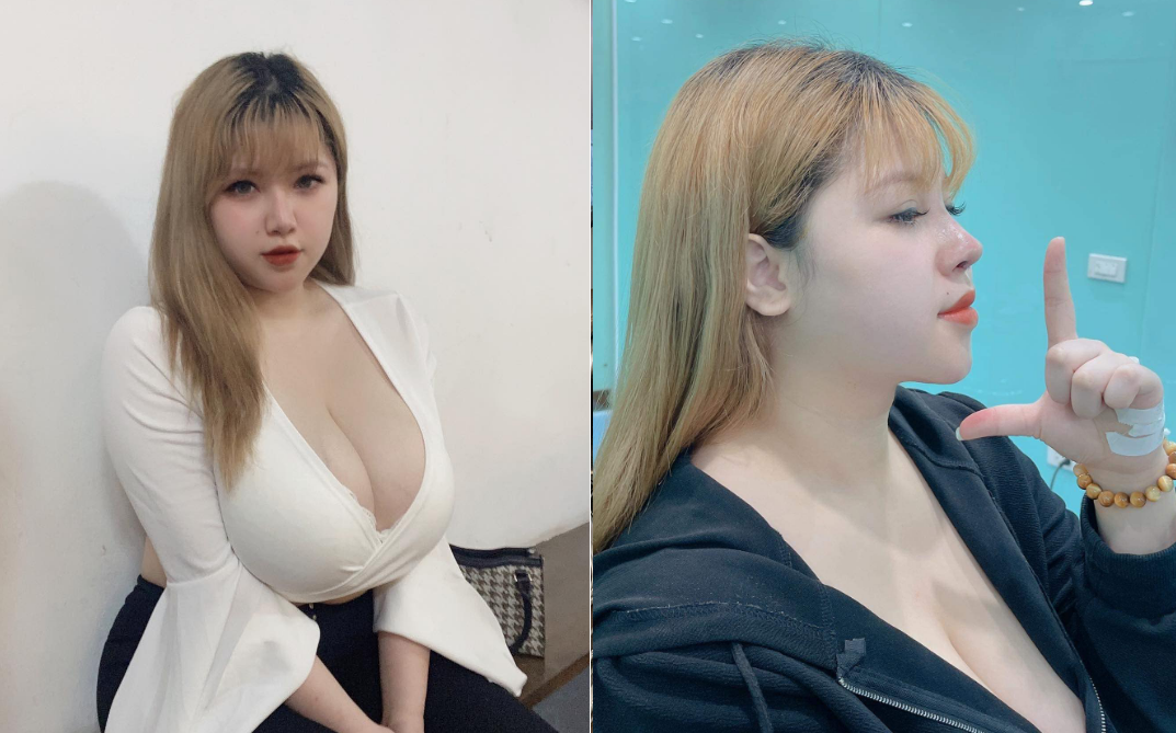 Phẫu thuật nâng mũi, hot girl ngực khủng tiết lộ: Được cả dàn trai đẹp bên cạnh xoa bóp!