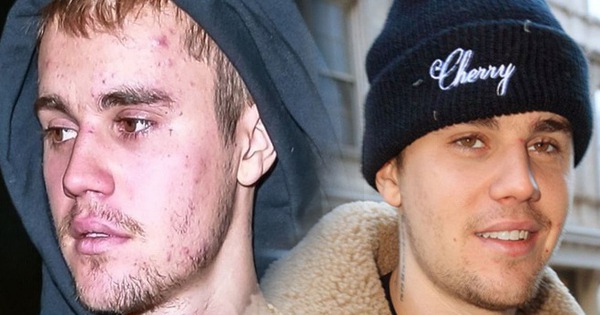 Bao năm bị tố lạm dụng ma tuý đá, Justin Bieber tiết lộ tình trạng bệnh tình thật sự khiến nhan sắc 