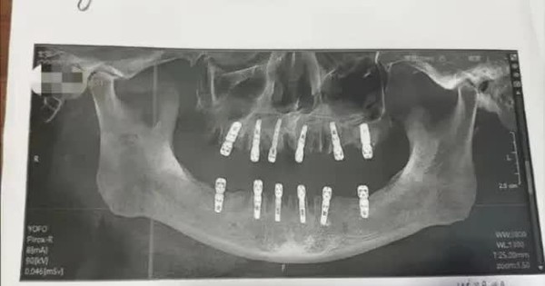 Tử vong sau khi nhổ 23 chiếc răng và trồng 12 răng giả cùng lúc - GIẢI TRÍ