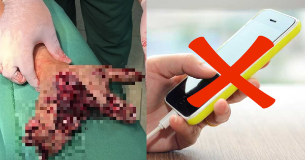 Vừa sạc pin vừa dùng điện thoại, người đàn ông Điện Biên bị chẻ đôi bàn tay