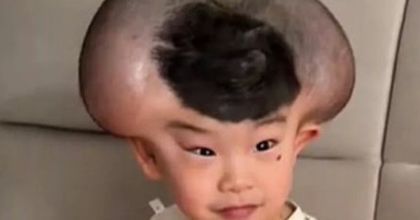 Nốt ruồi khổng lồ phủ kín hộp sọ khiến cậu bé có ngoại hình giống chuột Mickey