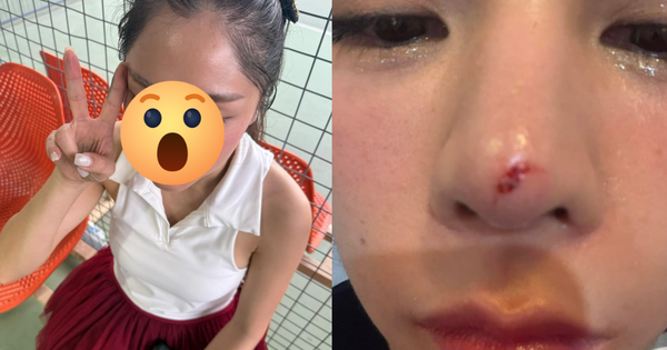 Thêm sao nữ Vbiz gặp tai nạn trên sân pickleball, vết thương chảy máu giữa mặt