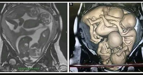 Ảnh siêu âm “chật kín” 4 em bé khiến hàng triệu người xem trầm trồ và cùng đặt 1 câu hỏi