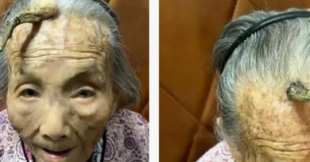 Cụ bà 107 tuổi bỗng mọc "sừng" trên trán, cộng đồng mạng bàn tán đưa ra lời khuyên