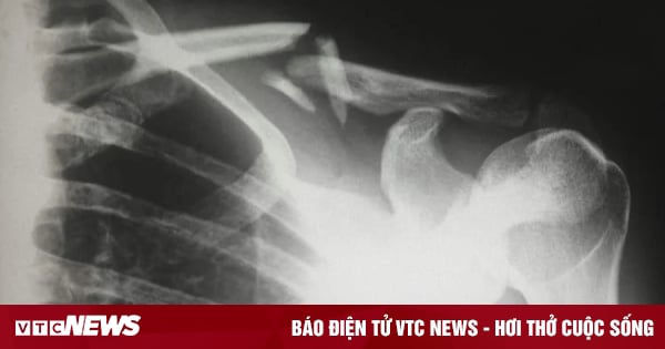 Dùng kem chống nắng quá mức, người phụ nữ bị gãy xương