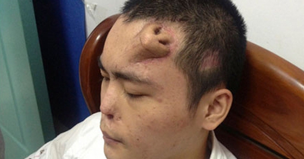 Không phải ảnh lỗi của AI, người đàn ông này đã thực sự mọc một chiếc mũi trên trán: Đó là 
