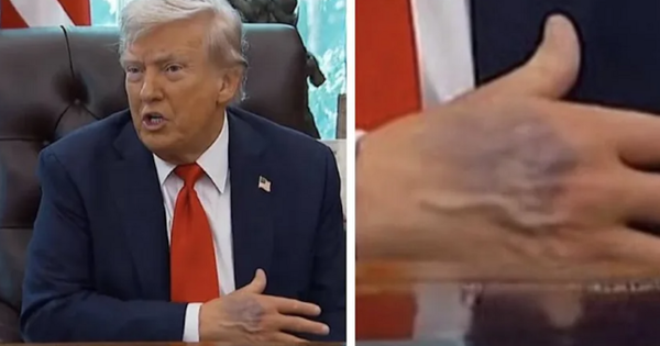 Bàn tay thâm tím của ông Trump gây chú ý