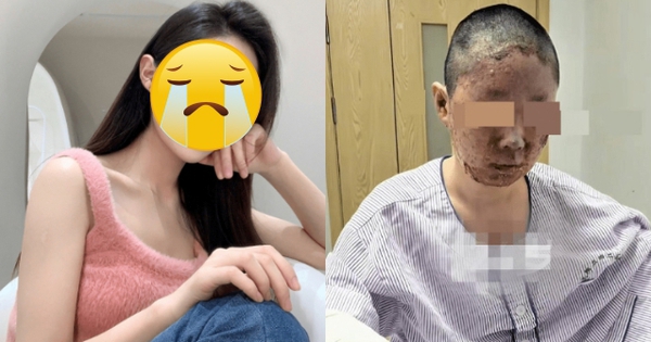 Sốc: Người mẫu 27 tuổi bỏng nặng, mặt biến dạng sau vụ nổ khí gas kinh hoàng