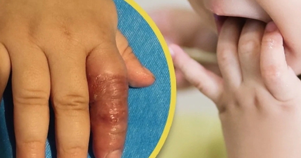 Mẹ dùng băng quấn để ngăn con mút tay, em bé suýt phải cắt cụt ngón