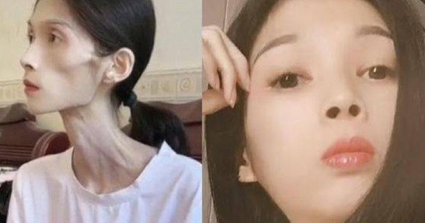 Số phận bi thảm của cô gái xinh đẹp biến thành 'bộ xương di động' 17kg