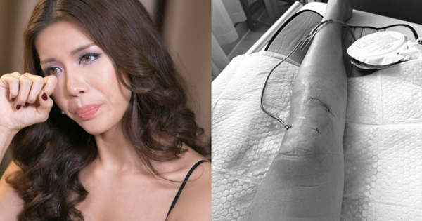 Siêu mẫu Minh Tú sốc vì bị đứt dây chằng chéo trước, rách sụn, dập xương